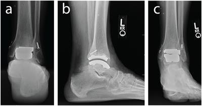 Methodology for Measurement of in vivo Tibiotalar Kinematics After Total Ankle Replacement Using Dual Fluoroscopy